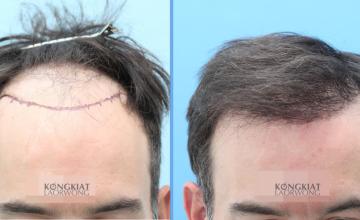 FUE 2620 grafts, 7 months result, Dr. Kongkiat Laorwong, MD, FISHRS Thailand