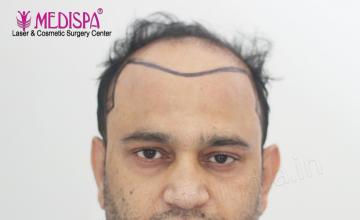 Dr. Suneet Soni - 5000 Grafts, Combine FUT + FUE + Beard, NW-VI