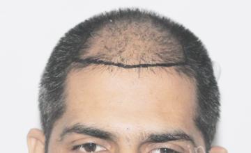 Dr. Suneet Soni - 4000 Grafts, Combine FUT + FUE + PRP, NW-V