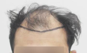 Dr. Suneet Soni - 5200 Grafts, Combine FUT + FUE + Beard Technique, NW-VI