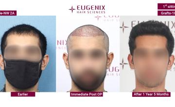 EUGENIX HAIR SCIENCES | NW2 | TRANSFORMATION | DR. ARIKA BANSAL