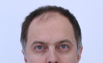 Dr Resul Yaman Hair Clinic - 4340 Grafts Result