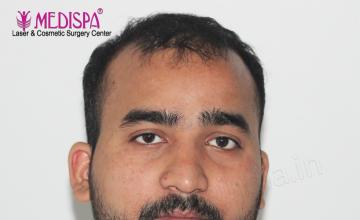 Dr. Suneet Soni - 4500 Grafts, Combine FUT + FUE + Beard Technique , NW- IV