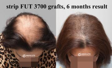 Dr. Kongkiat Laorwong, MD, FISHRS,  strip FUT Female 3700 grafts, 6 months post op