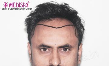 Dr. Suneet Soni - 3600 Grafts, Combine FUT + FUE Method, NW-IV