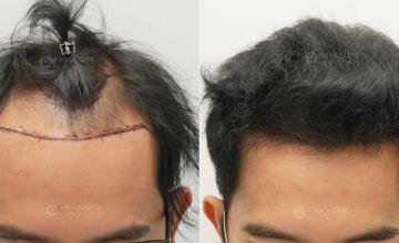 Dr. Kongkiat Laorwong, MD, FISHRS, FUE 3100 grafts, 7 months post op