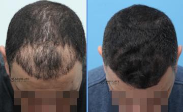 Dr.Kongkiat Laorwong, FISHRS, Thailand, FUE 1786 grafts