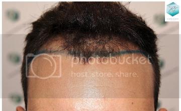 Dr. Rafael de Freitas - 3021 Grafts - FUE