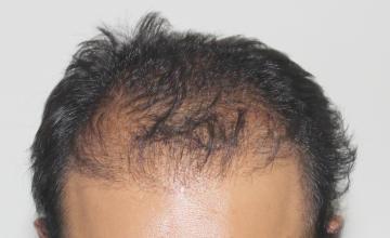 Corrective hair transplant with Dr. Suneet Soni - 3000 FUT Grafts