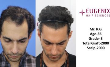 EUGENIX HAIR SCEINCES | GRADE 3 | 39 MONTHS RESULT| Dr. Pradeep Sethi