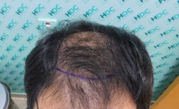 4170 Grafts FUE Result – 10 months after – Dr Christina – HDC Hair Clinic