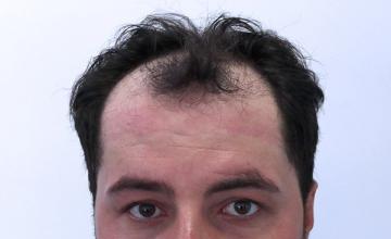 Dr Resul Yaman Hair Clinic - 3760 Grafts Result