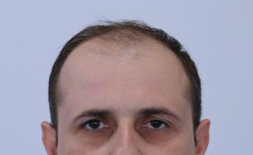 Dr Resul Yaman Hair Clinic - 4680 Grafts Result