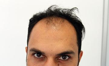 Dr Resul Yaman Hair Clinic - 4210 Grafts Result