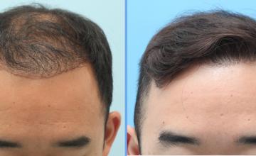 Dr.Kongkiat Laorwong, FISHRS, Thailand, FUE 3060 grafts