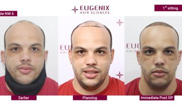 EUGENIX HAIR SCIENCES | RESTORATION OF HAIRS AND CONFIDENCE | NW6
