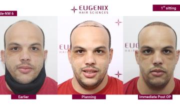 EUGENIX HAIR SCIENCES | RESTORATION OF HAIRS AND CONFIDENCE | NW6