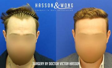 Dr. Hasson / 3,000 grafts / hairline / dense pack / FUE / 19 months post-op