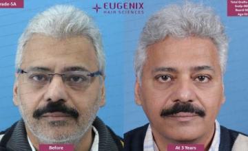 Grey Hair Transplant | 4108 grafts @ Eugenix | 3-year results
