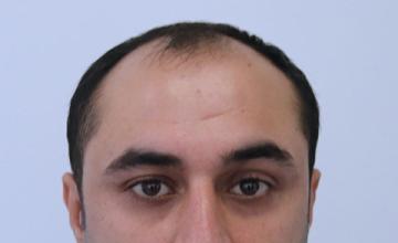 Dr Resul Yaman Hair Clinic - 4640 Grafts Result