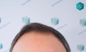 Dr. Rafael de Freitas - 3362 Grafts / 8806 Hairs - FUE