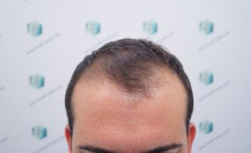 Dr. Rafael de Freitas - 3.437 Grafts - 8.071 Hairs - FUE