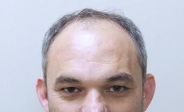 Dr Resul Yaman Hair Clinic - 4950 Grafts - 7 Years Result