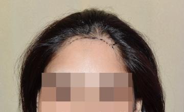 Dr Suneet Soni - Female Hair Transplant / 1700 Grafts / Unshaven FUT Technique