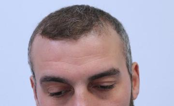 Dr Resul Yaman Hair Clinic - 4340 Grafts Result