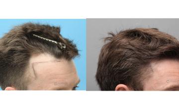 Dr. Kongkiat Laorwong, MD, FISHRS,  FUE 1790 grafts