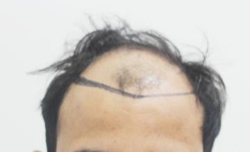 Dr. Suneet Soni - 4400 Grafts, Combine FUT + FUE Technique , NW-V