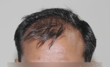 Dr. Suneet Soni - Grafts ~3900, FUT Method, NW-IV