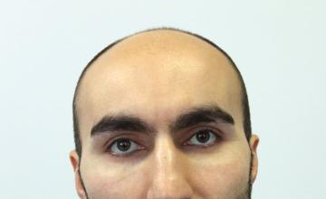 Dr Resul Yaman Hair Clinic - 4415 Grafts 7 Months Before - After Result