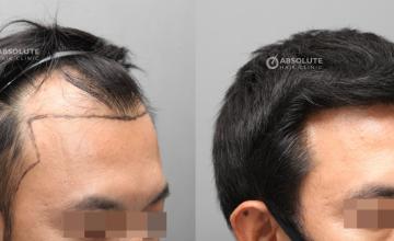 Dr. Kongkiat Laorwong, MD, FISHRS,  FUE 3100 grafts, 6 months post op with VDO.