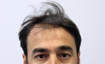 Dr Resul Yaman Hair Clinic - 3430 Grafts Result
