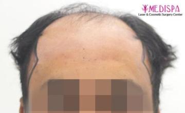 Dr. Suneet Soni - 5400 Grafts, FUT, FUE & Beard Combination