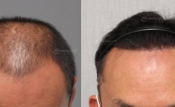 Dr. Kongkiat Laorwong, MD, FISHRS,  FUE 4000 grafts, 12 months post op