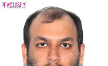 Dr. Suneet Soni - 4500 Grafts, Combine FUT + FUE + Beard Technique , NW- VI