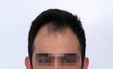 Dr Resul Yaman Hair Clinic - 2260 Grafts Result