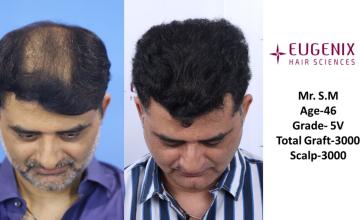 EUGENIX HAIR SCEINCES | GRADE 5V | 42 MONTHS RESULT| Dr. Priyadarshini Das