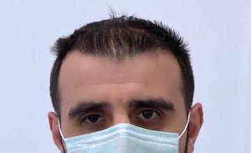 Dr Resul Yaman Hair Clinic - 4280 Grafts Result
