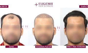 EUGENIX HAIR SCIENCES | EVERY GRAFT IS IMPORTANT | NW3V |