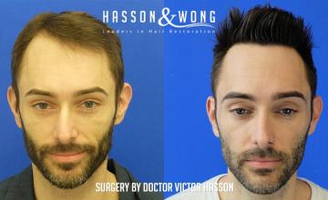Dr. Hasson / 2,700 grafts / hairline / dense pack / FUE / 15 months post-op