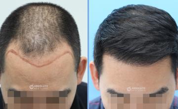 Dr.Kongkiat Laorwong, FISHRS, Thailand, FUE 2890 grafts