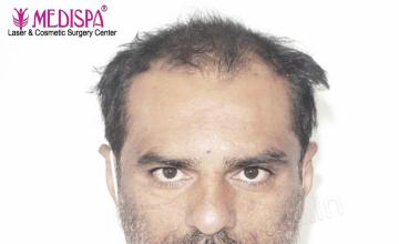 Dr. Suneet Soni - 5000 Grafts, Combine FUT + FUE + Beard, Natural Hairline