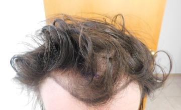 Hairline FUE Result for 2500 Grafts – 8 Months After – HDC Hair Clinic