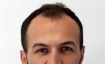 Dr Resul Yaman Hair Clinic - 4140 Grafts Result