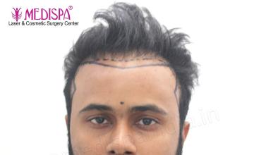 Revision & Hairline Correction – 3500 Grafts – Dr. Suneet Soni, Medispa India