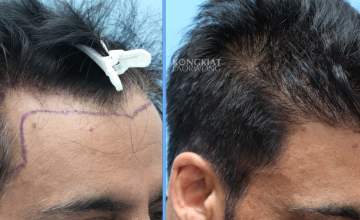 FUE 1709 grafts, Dr. Kongkiat Laorwong, MD,FISHRS, Bangkok Thailand