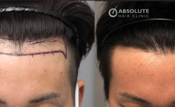 Dr. Kongkiat Laorwong, MD, FISHRS, male hairline FUE 1920 grafts, 12 months post op